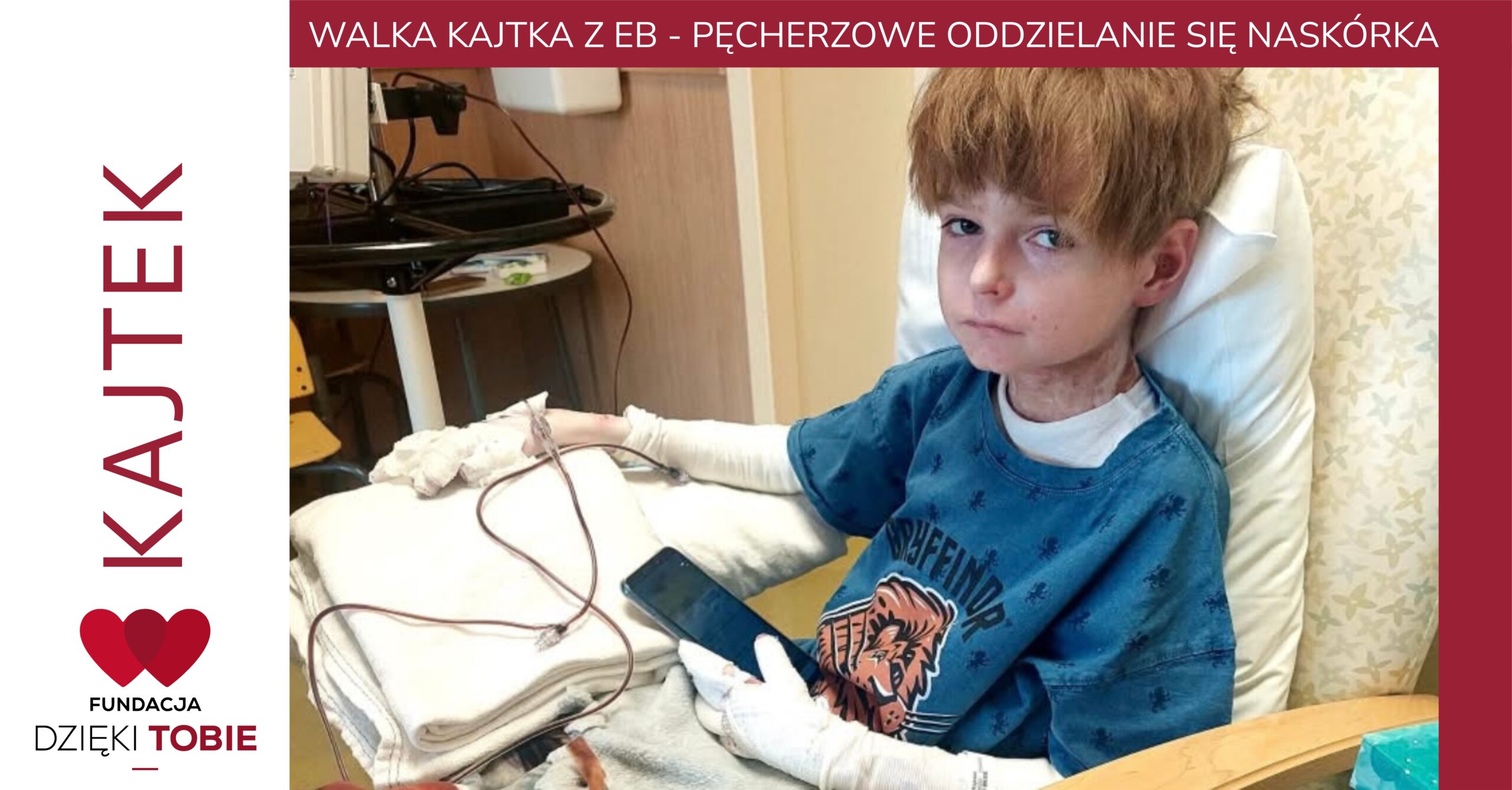 WALKA KAJTKA Z EB – PĘCHERZOWE ODDZIELANIE SIĘ NASKÓRKA